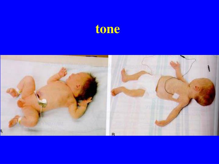 PPT Same gestational age SGA AGA LGA PowerPoint Presentation ID757401