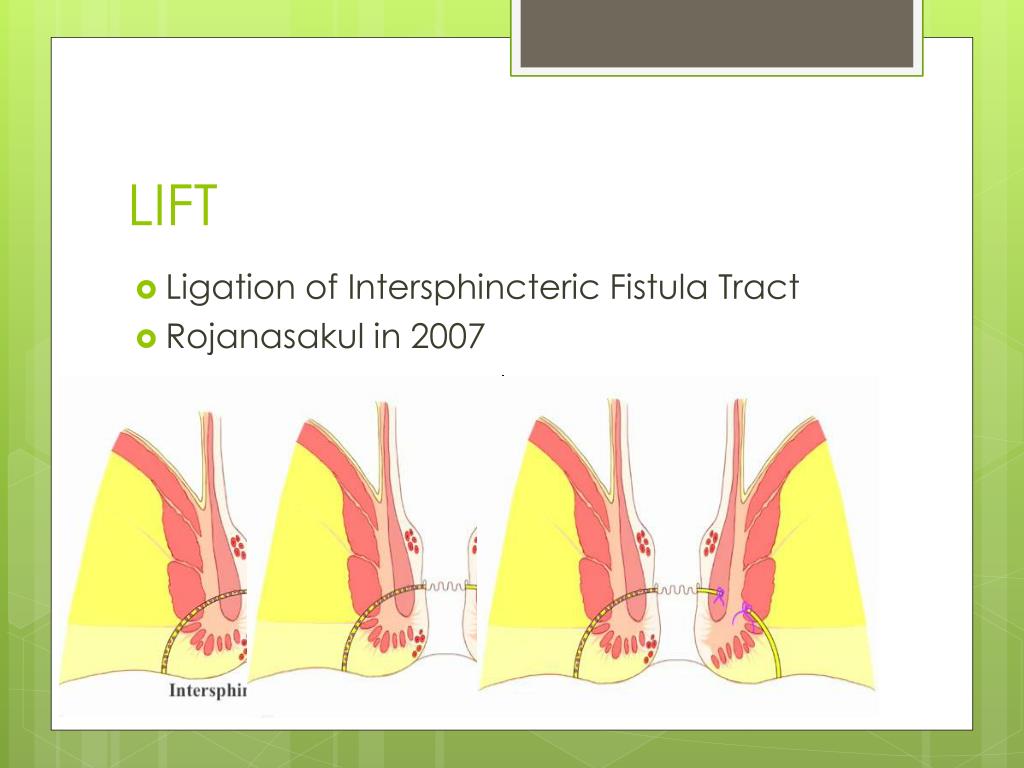 PPT The Best Surgical Treatment for Fistulainano PowerPoint