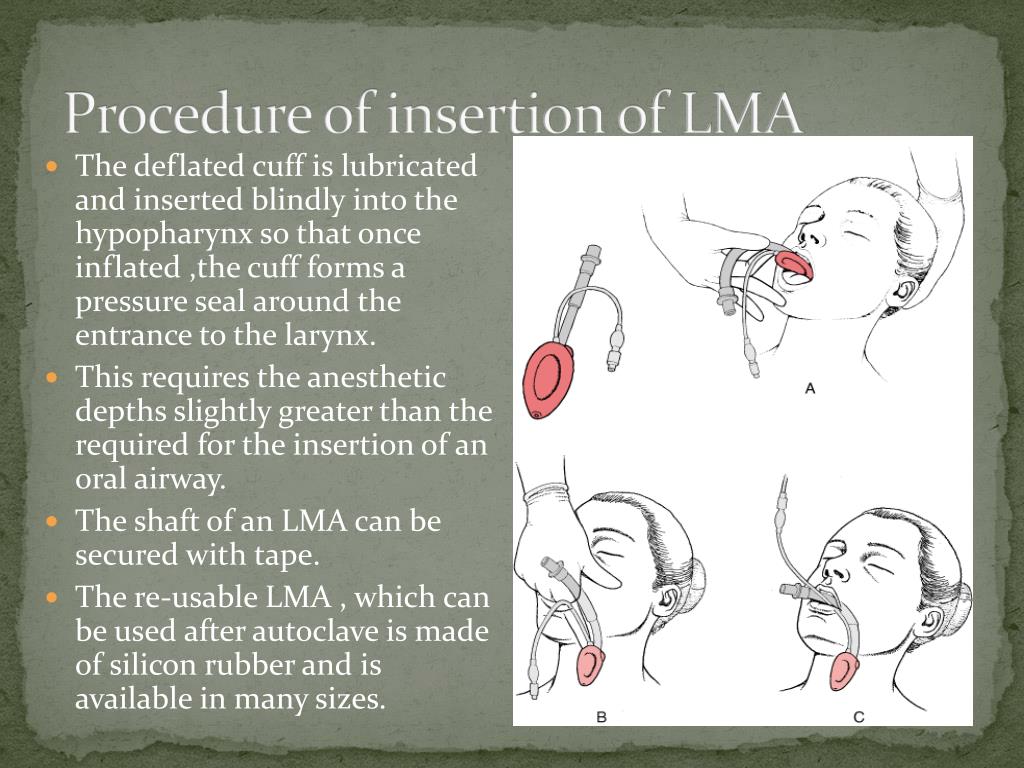 PPT LARYNGEAL MASK AIRWAY (LMA) PowerPoint Presentation, free