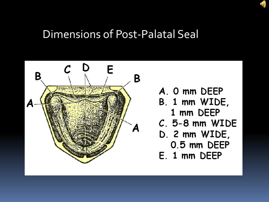 PPT Posterior Palatal Seal PowerPoint Presentation, free download