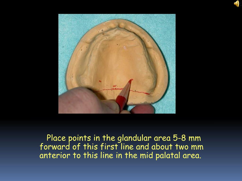 PPT Posterior Palatal Seal PowerPoint Presentation, free download