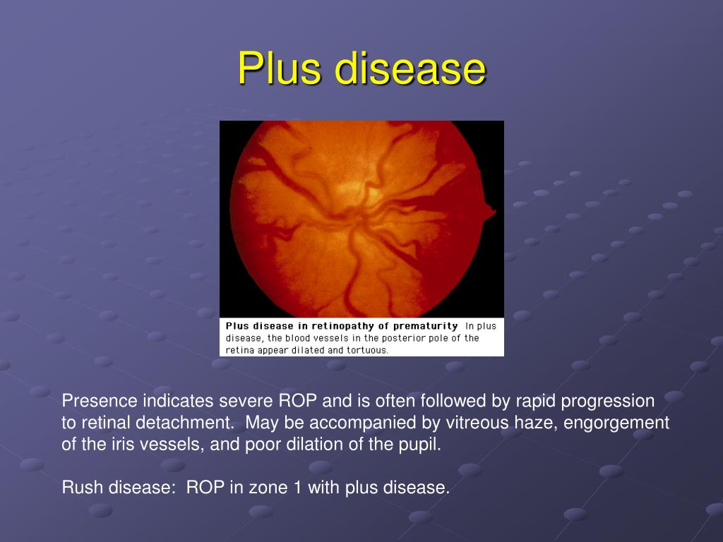 PPT Retinopathy of Prematurity PowerPoint Presentation, free download
