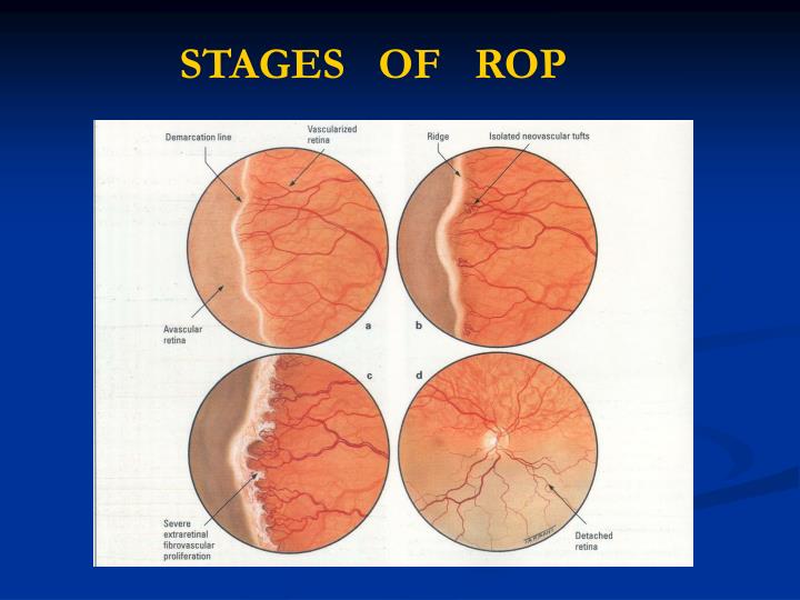 PPT RETINOPATHY OF PREMATURITY PowerPoint Presentation ID861925