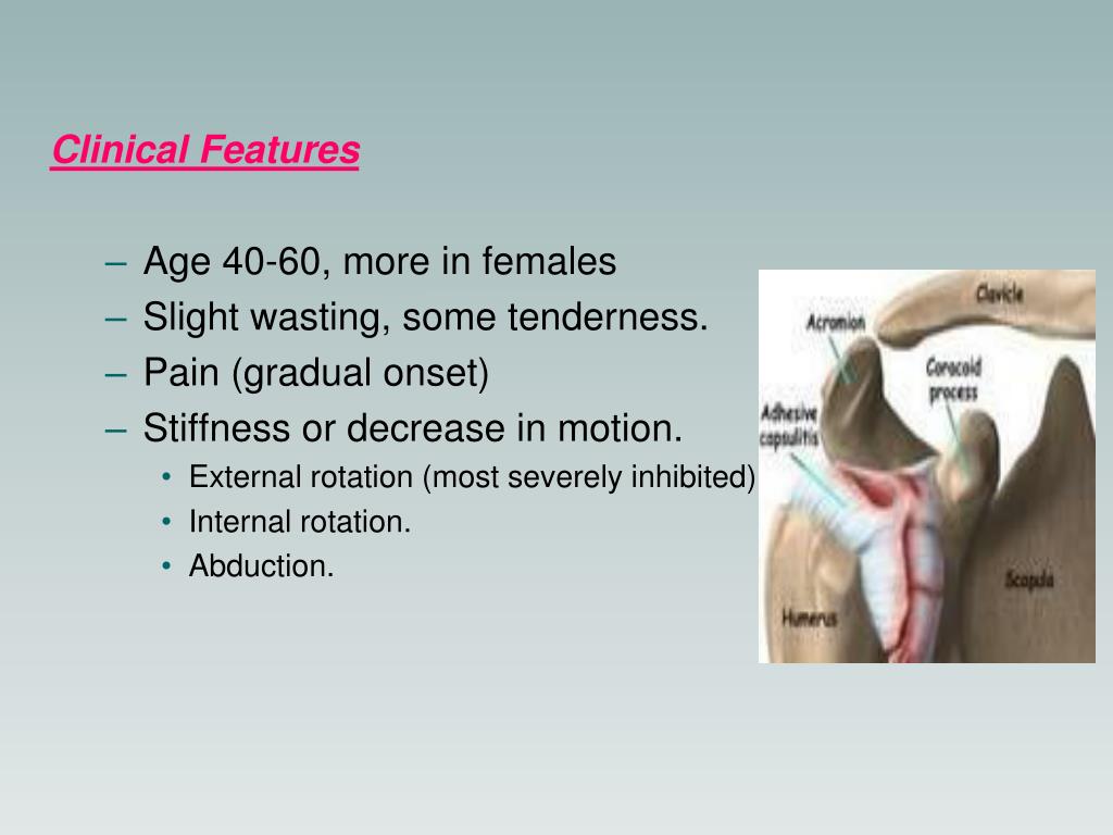 PPT Adhesive Capsulitis (Frozen Shoulder) PowerPoint Presentation