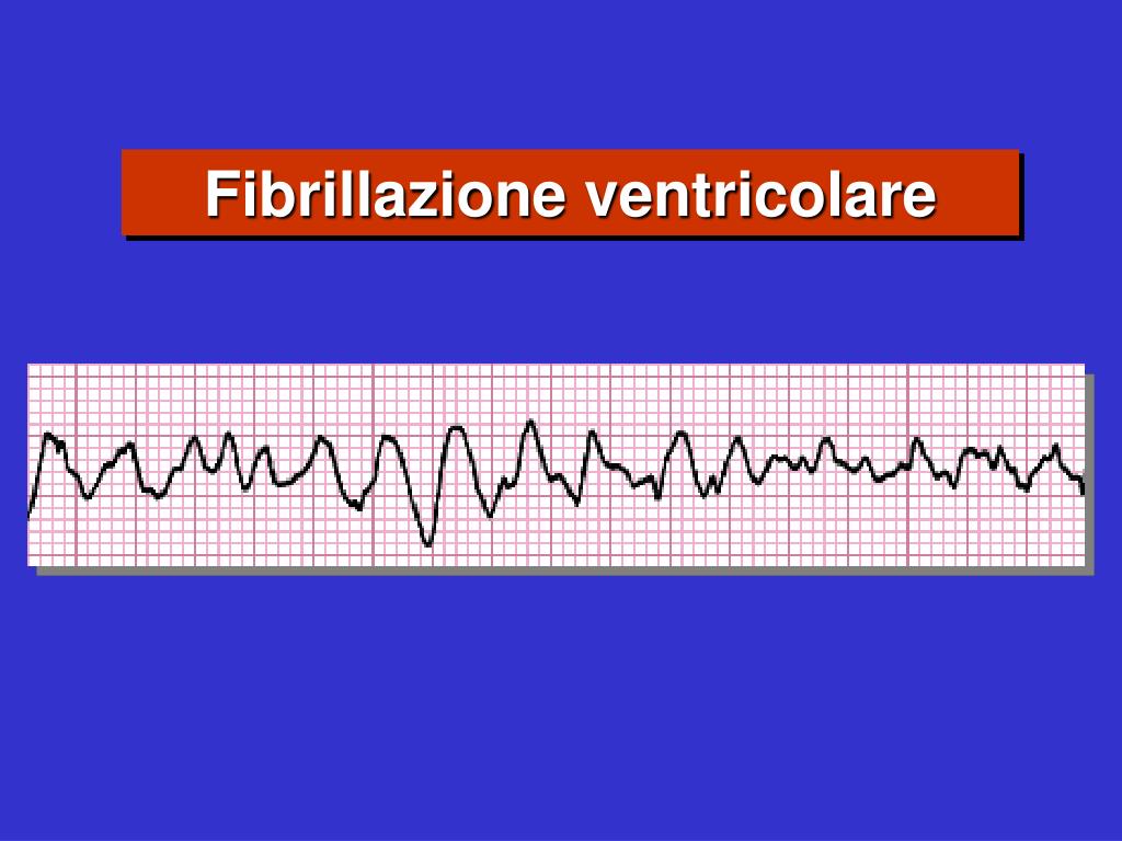 Ppt - International Guidelines 2000 For Cpr And Ecc: A Consensus On Science Ilcor 2000 Powerpoint Presentation - Id:879366 768_x_1024_jpg