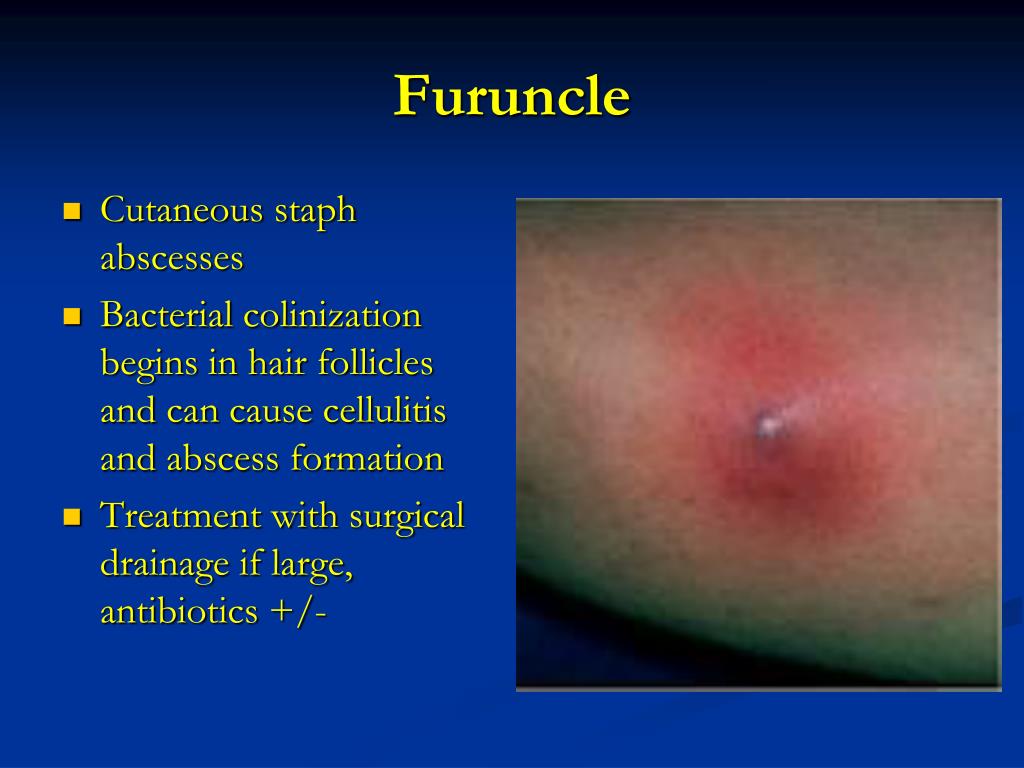 PPT Surgical Infections PowerPoint Presentation, free download ID