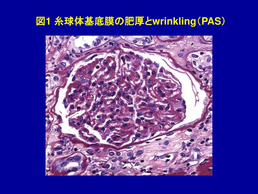 PPT 良性腎硬化症 PowerPoint Presentation ID931828