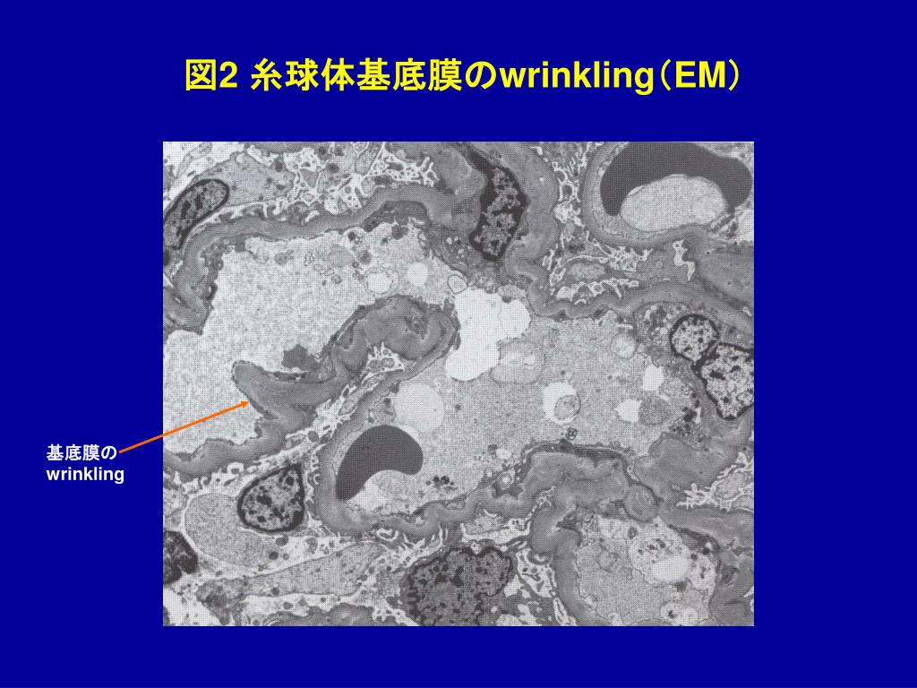 PPT 良性腎硬化症 PowerPoint Presentation ID931828