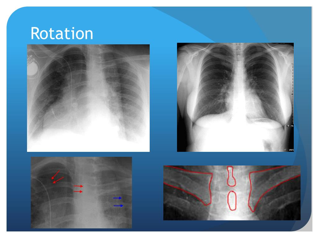 PPT Chest XRay Interpretation for the Internist PowerPoint