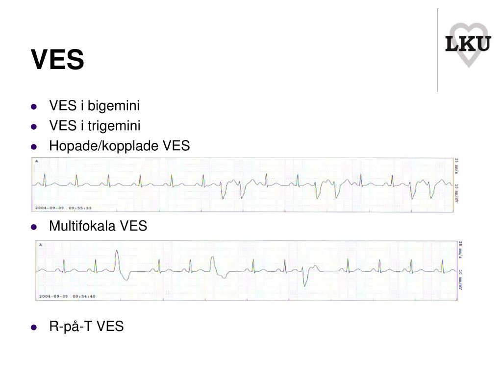 PPT EKG PowerPoint Presentation, free download ID935381