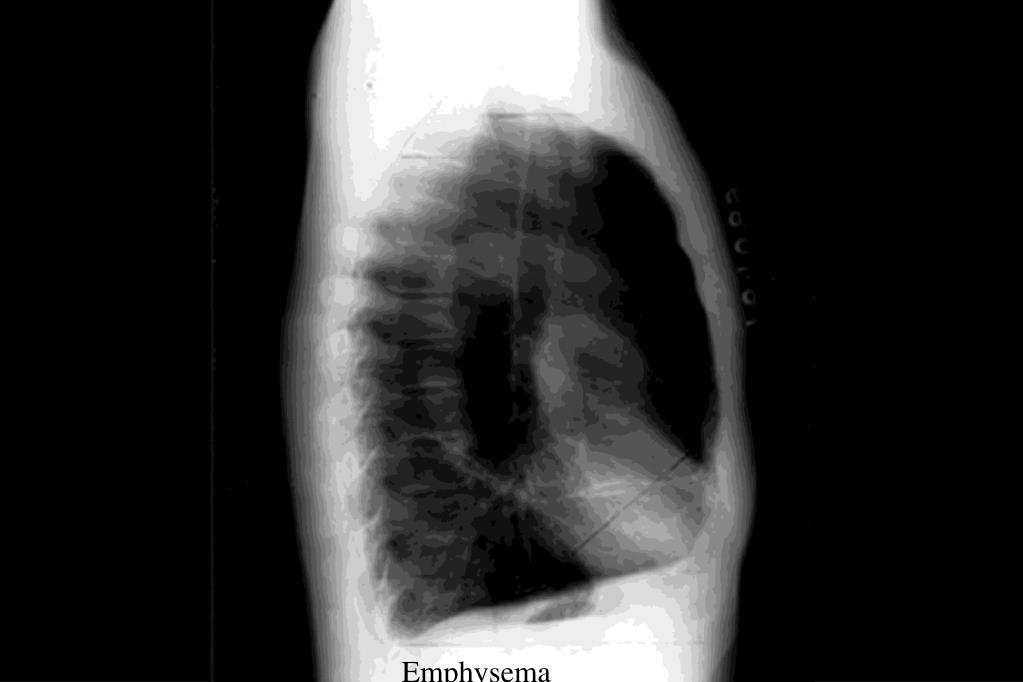 PPT Chest XRays Every Resident Should Know Part 2 PowerPoint