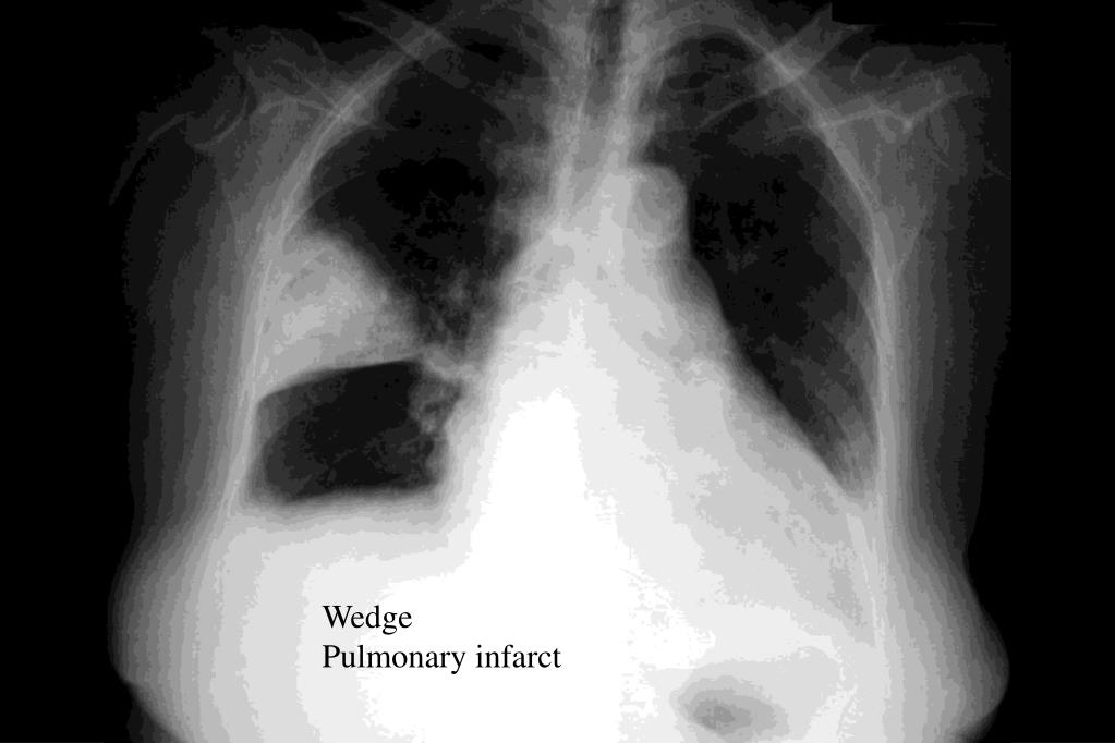 PPT Chest XRays Every Resident Should Know Part 2 PowerPoint