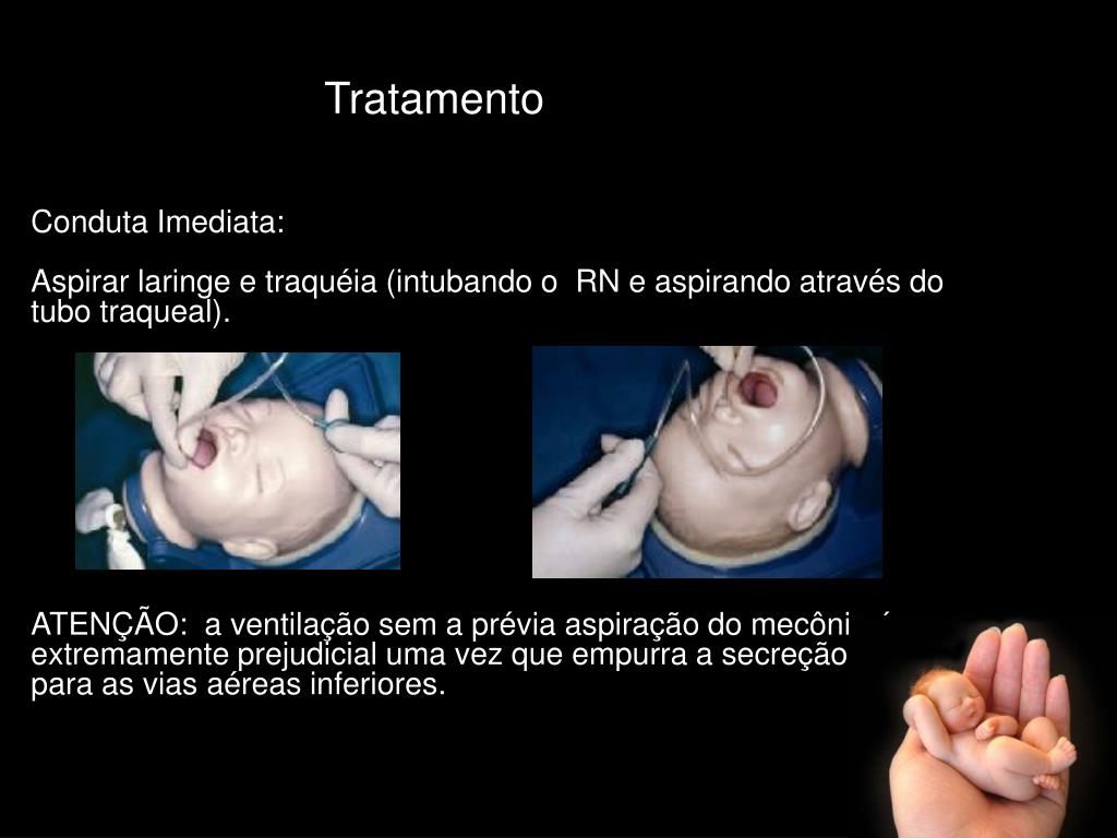 PPT Síndrome de Aspiração de Mecônio PowerPoint Presentation, free
