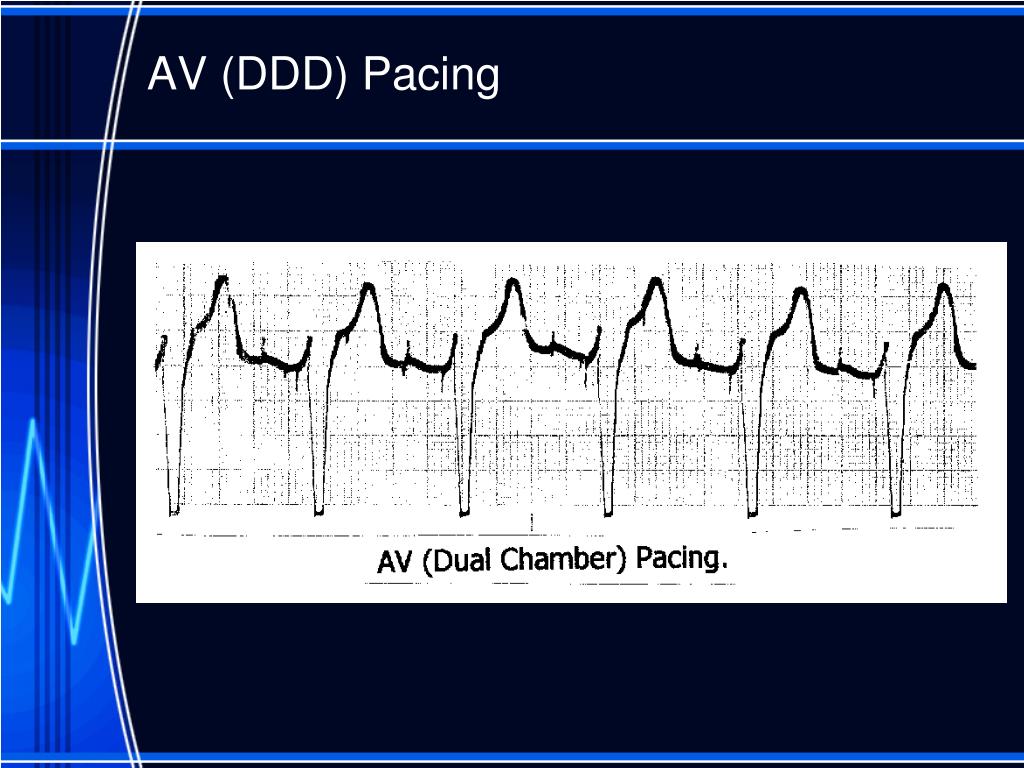PPT Basic Cardiac Pacing PowerPoint Presentation, free download ID