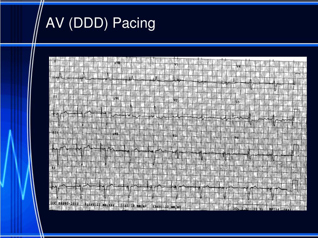 PPT Basic Cardiac Pacing PowerPoint Presentation, free download ID