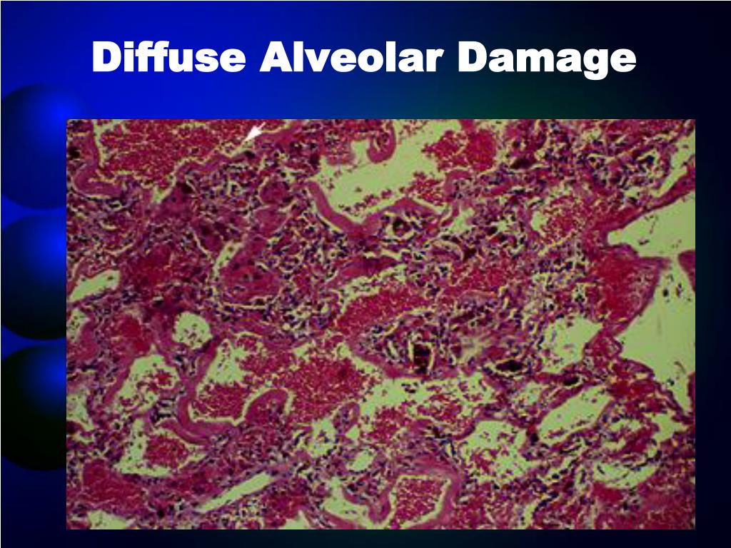 Ppt Diagnosis In Diffuse Alveolar Hemorrhages Powerpoint Presentation
