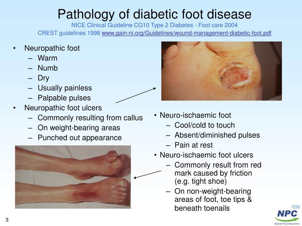 PPT Wounds Diabetic foot PowerPoint Presentation, free download ID