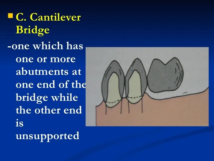 1. fixed partial denture finals1