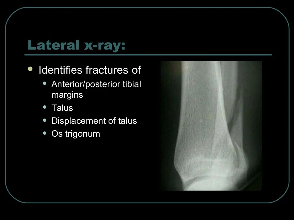 X Ray Ankle Cpt