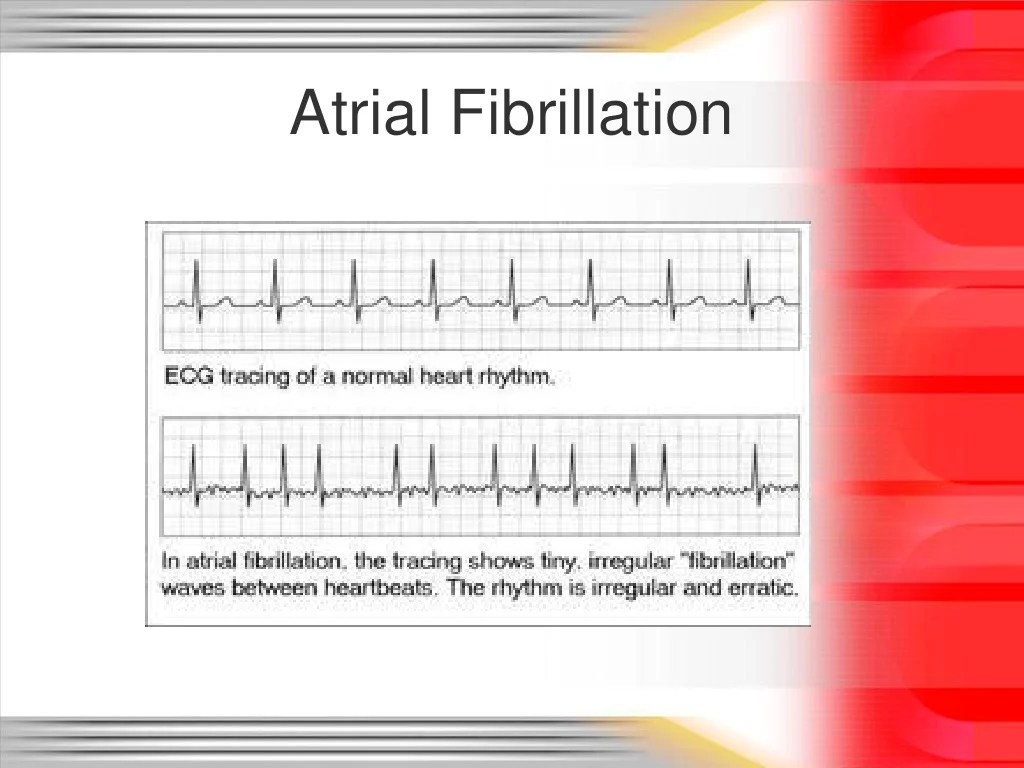 Arrhythmia basics