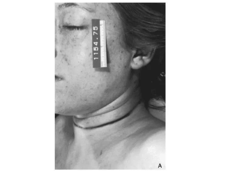 Asphyxia presentation