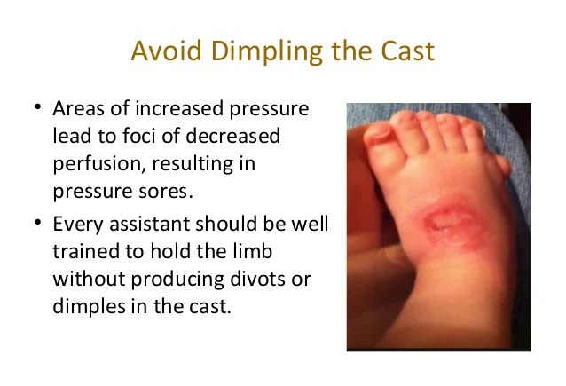 Casting and splinting principles and common pitfalls