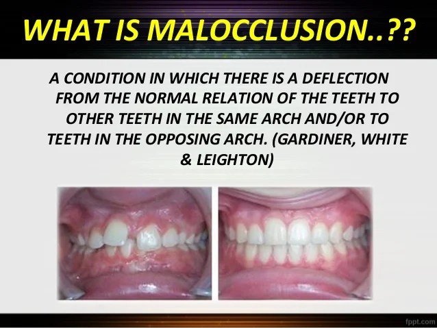 What Is Malocclusion Of The Teeth TeethWalls