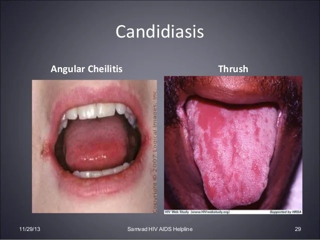 Candidiasis genital fluconazole, yeast infection sitz bath vinegar