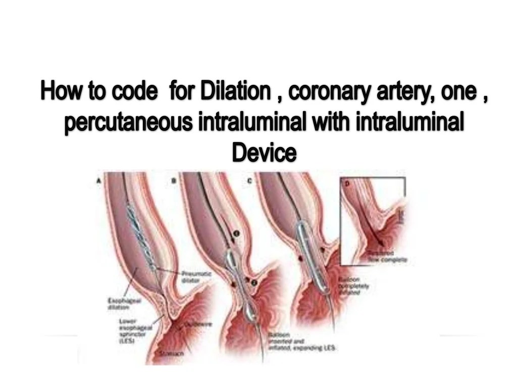 ICD10CM , ICD10PCS cardiovascular presentation