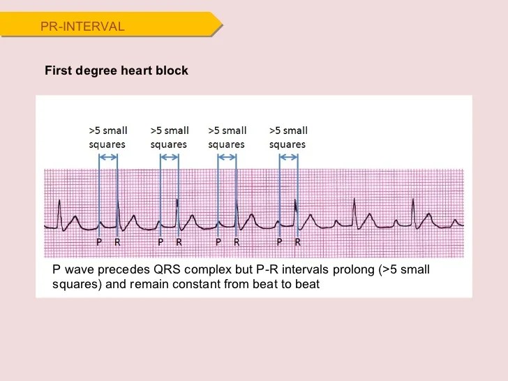 ECG