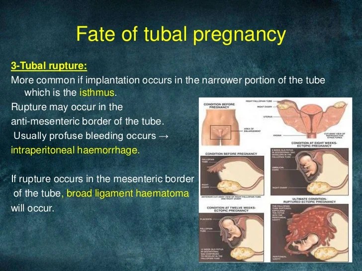 Ectopic pregnancy