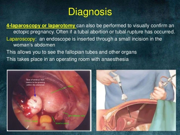 Early Signs Of Ectopic Pregnancy At 4 Weeks PregnancyWalls