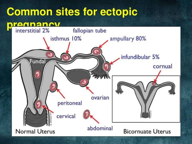Ectopic pregnancy