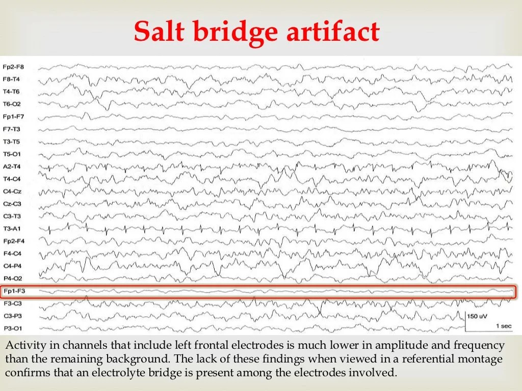 Eeg Electrode Pop Artifact at Felix Flakes blog