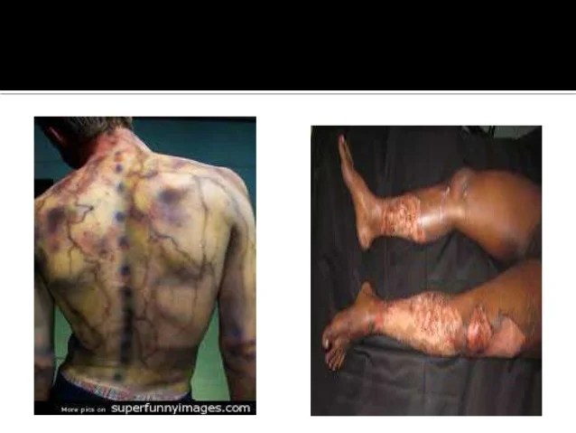 electrocution injuries Gallery