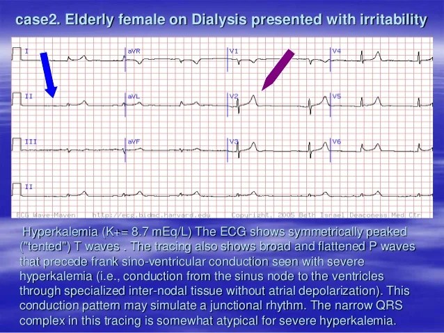Hypocalcemia Ecg Changes