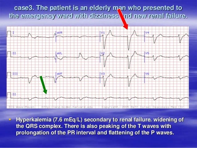 Hypocalcemia Ecg Changes
