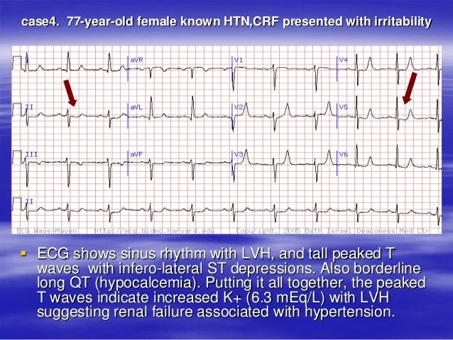 Hypocalcemia Ecg Changes