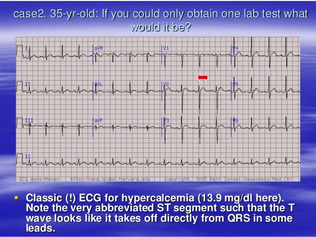 Electrolytes imbalance and ECG changes presentation 2005
