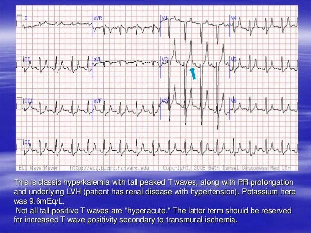 Hypocalcemia Ecg Changes