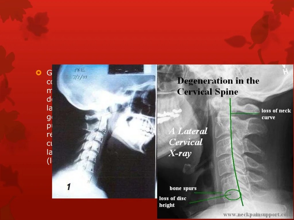 Esguince cervical