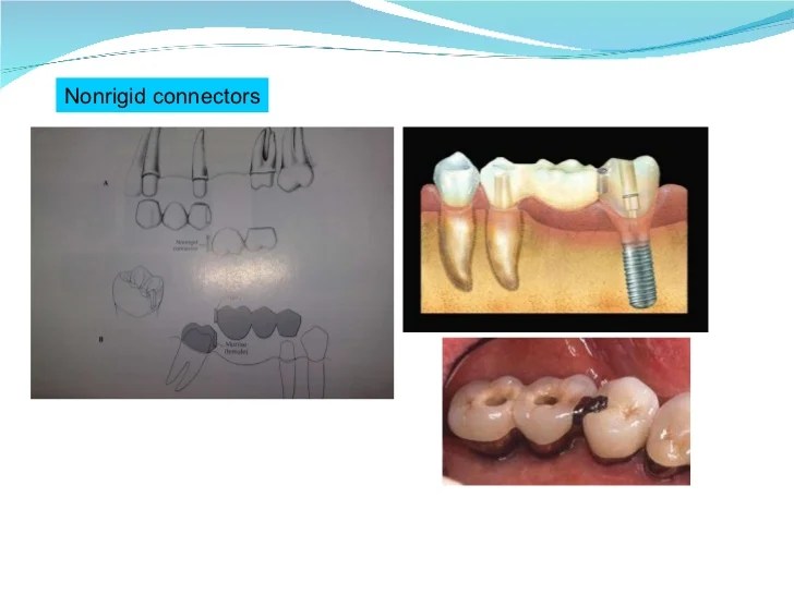 Introduction to fixed partial denture