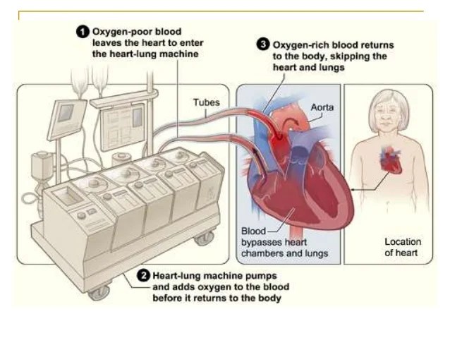 open heart surgery on emaze
