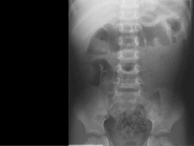 Intussusception