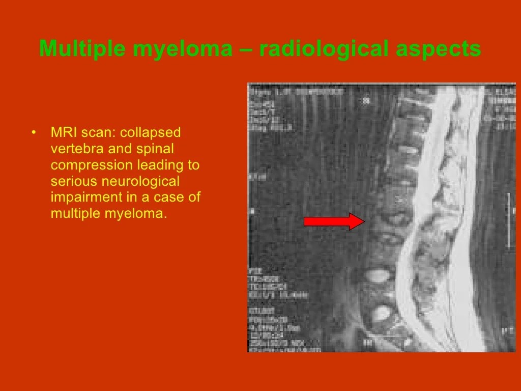 Monoclonal Gammopathies