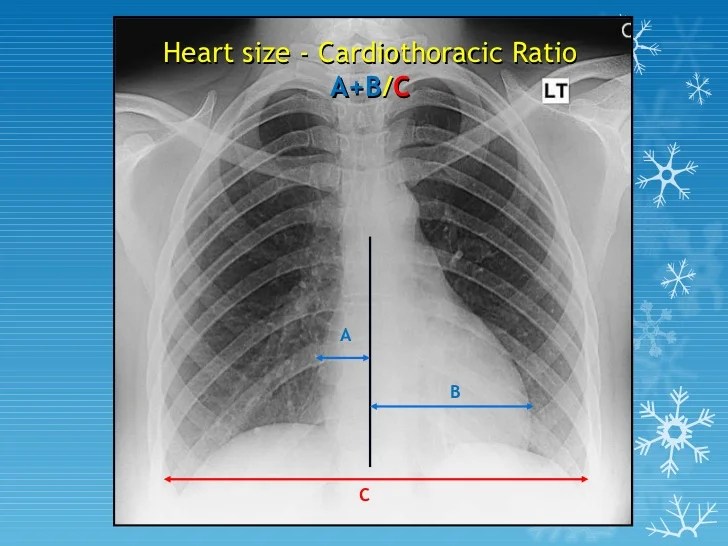 basics of chest X ray interpretation