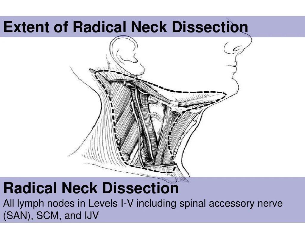 Neck dissection