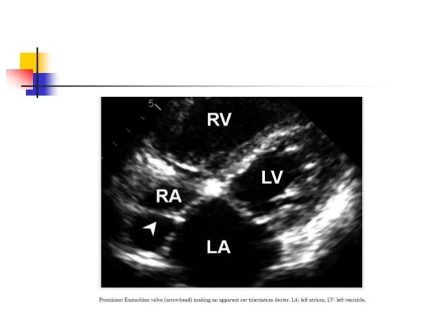 Normal variants of heart structures