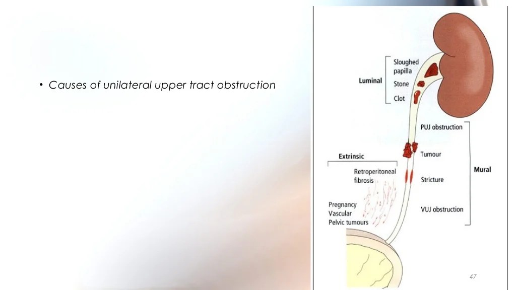 Obstructive Uropathy Icd 10 / ICD10 Codes for COPD Symptoms of COPD and Treatments