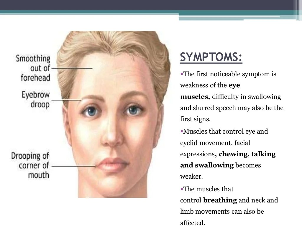 myasthenia gravis